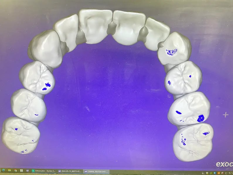 Full Zirconia Crowns 3